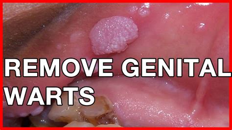 reddit genital warts|how to remove warts reddit.